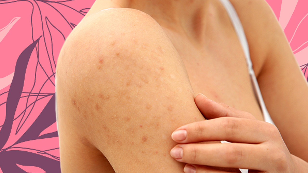 Beauty tips | చర్మంపై బ్లాక్ హెడ్స్ వేధిస్తున్నాయా.. ఈ చిట్కాలతో వెంటనే చెక్ పెట్టేయండి.. Beauty tips | చర్మంపై బ్లాక్ హెడ్స్ వేధిస్తున్నాయా.. ఈ చిట్కాలతో వెంటనే చెక్ పెట్టేయండి..