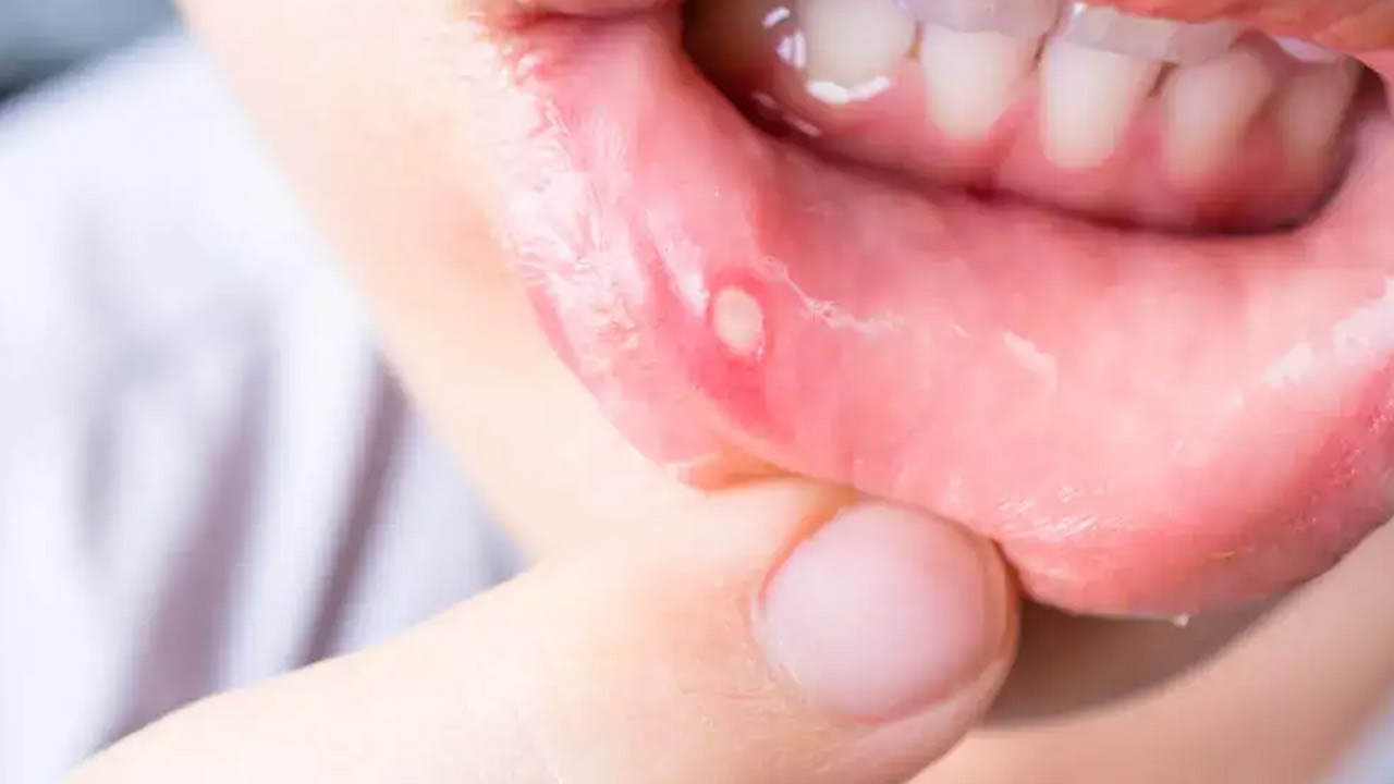 Mouth ulcer | నోట్లో పుండ్లతో యాతన పడుతున్నారా.. ఈ సింపుల్ చిట్కాలు మీ కోసమే..! Mouth ulcer | నోట్లో పుండ్లతో యాతన పడుతున్నారా.. ఈ సింపుల్ చిట్కాలు మీ కోసమే..!