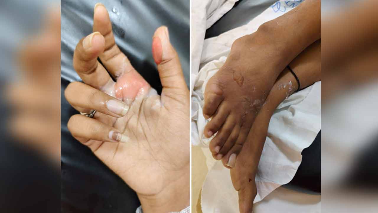 స్నానం నీటిలో యాసిడ్.. కాలిన గాయాలతో ఆస్పత్రి పాలైన బీటెక్ విద్యార్థిని స్నానం నీటిలో యాసిడ్.. కాలిన గాయాలతో ఆస్పత్రి పాలైన బీటెక్ విద్యార్థిని