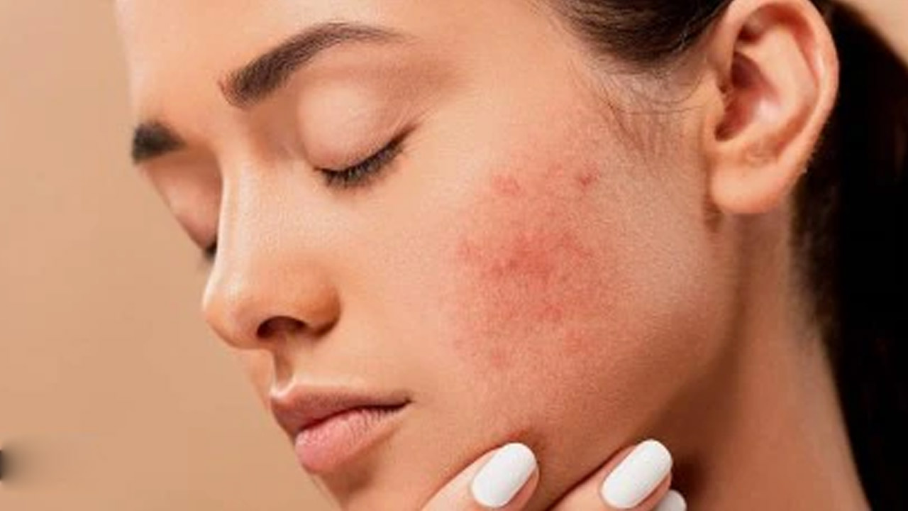 Pimples | మొటిమలతో ముఖం చూపించలేకపోతున్నారా.. ఈ టిప్స్ మీ కోసమే.. Pimples | మొటిమలతో ముఖం చూపించలేకపోతున్నారా.. ఈ టిప్స్ మీ కోసమే..