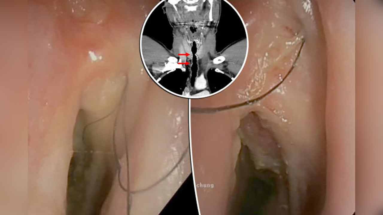 Hair in Throat | చైన్ స్మోకర్ గొంతులో పెరిగిన వెంట్రుకలు.. 15 ఏండ్లు నరకయాతన.. అతని కథ వింటే షాక్ అవ్వాల్సిందే..! Hair in Throat | చైన్ స్మోకర్ గొంతులో పెరిగిన వెంట్రుకలు.. 15 ఏండ్లు నరకయాతన.. అతని కథ వింటే షాక్ అవ్వాల్సిందే..!