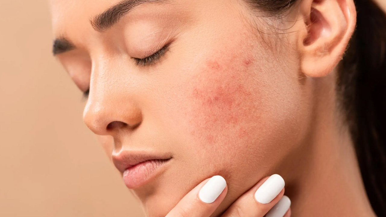 Beauty tips | ముఖంపై మచ్చలు మీ అందాన్ని తగ్గిస్తున్నాయా.. అయితే ఈ స్పెషల్ టిప్స్ మీ కోసమే..! Beauty tips | ముఖంపై మచ్చలు మీ అందాన్ని తగ్గిస్తున్నాయా.. అయితే ఈ స్పెషల్ టిప్స్ మీ కోసమే..!