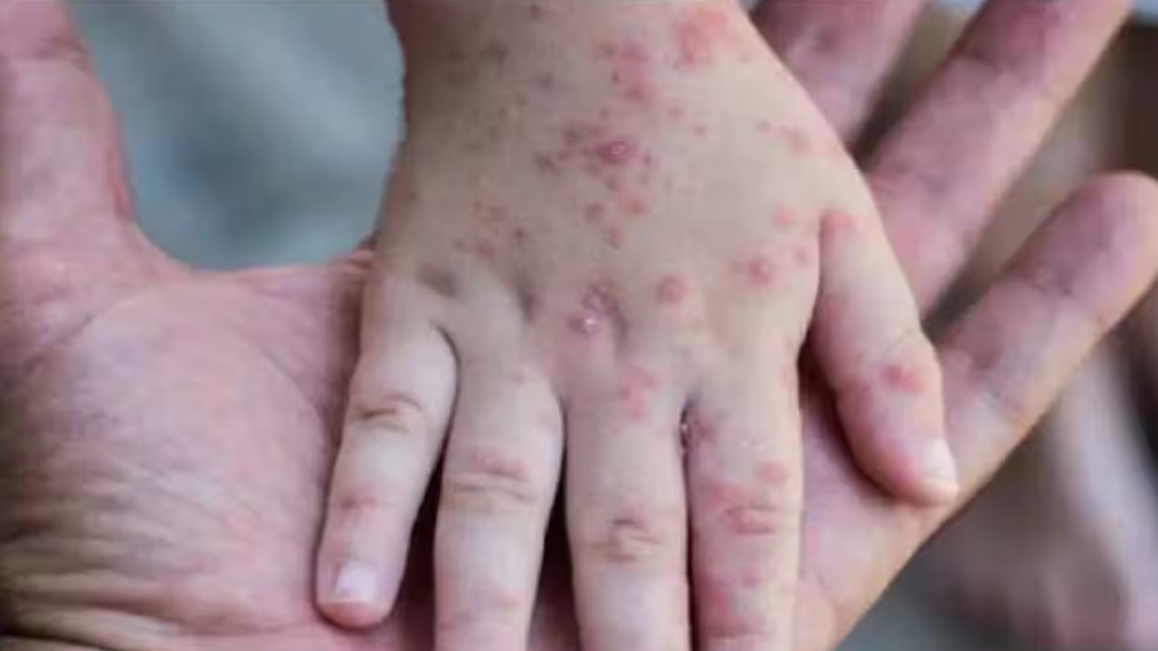 Monkey Pox | దుబాయ్ నుంచి వచ్చిన చిన్నారిలో మంకీపాక్స్ లక్షణాలు.. అప్రమత్తమైన ఏపీ ప్రభుత్వం..! Monkey Pox | దుబాయ్ నుంచి వచ్చిన చిన్నారిలో మంకీపాక్స్ లక్షణాలు.. అప్రమత్తమైన ఏపీ ప్రభుత్వం..!