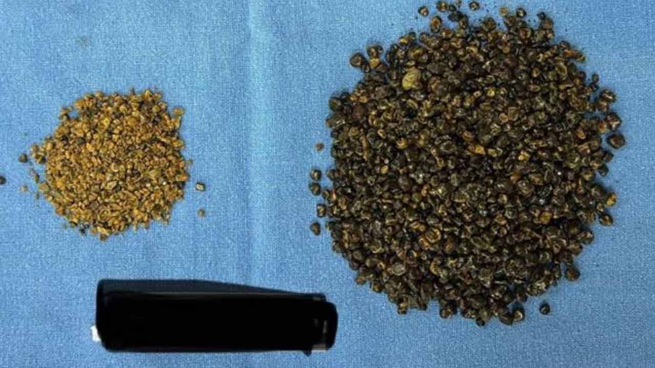 Gallbladder stones | వృద్ధుడి కడుపులో 8 వేల రాళ్లు.. లెక్కించేందుకు 6 గంటల సమయం.. Gallbladder stones | వృద్ధుడి కడుపులో 8 వేల రాళ్లు.. లెక్కించేందుకు 6 గంటల సమయం..