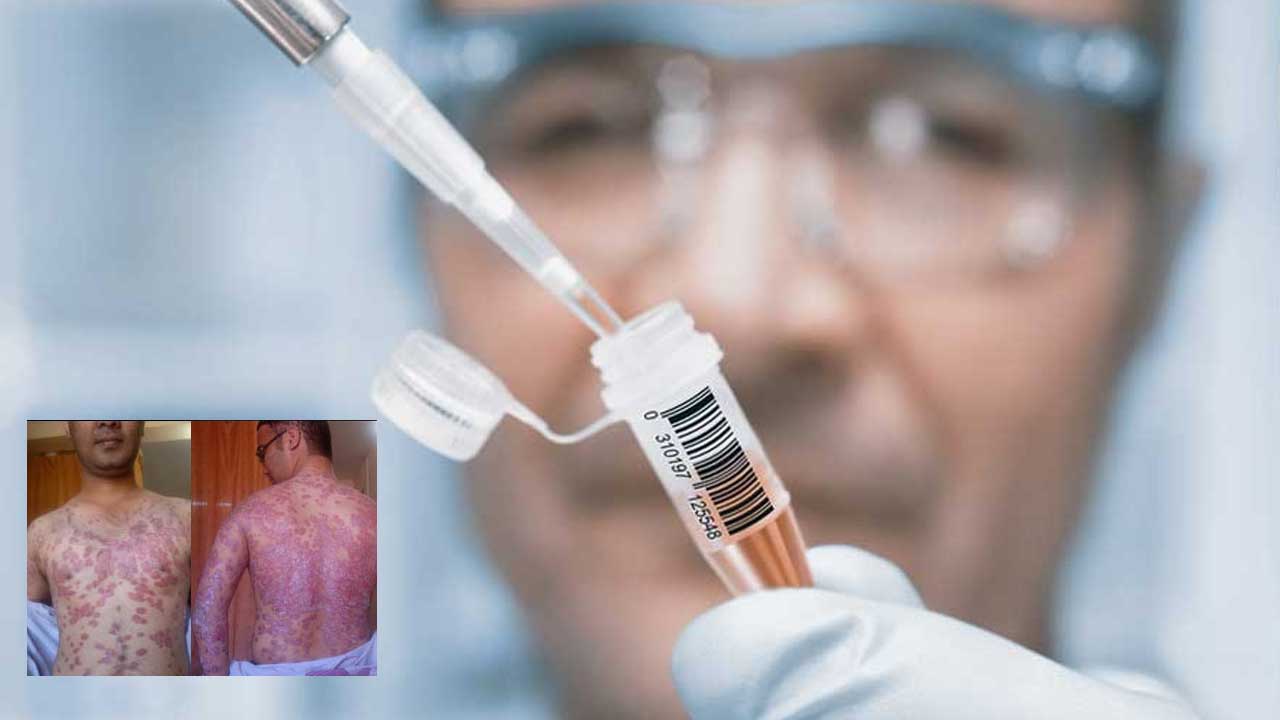 Sun Pharma: సొరియాసిస్ రోగులకు చేదు వార్త.. ఆ ట్రయల్స్ ఫెయిల్ Sun Pharma: సొరియాసిస్ రోగులకు చేదు వార్త.. ఆ ట్రయల్స్ ఫెయిల్