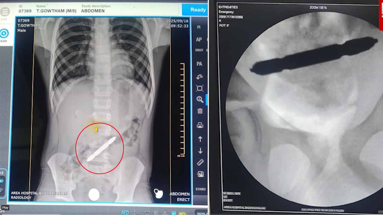 Screwdriver | బాలుడి పెద్ద‌పేగులో అడ్డంగా ఇరుక్కున్న స్క్రూ డ్రైవ‌ర్.. తొల‌గించిన వైద్యులు