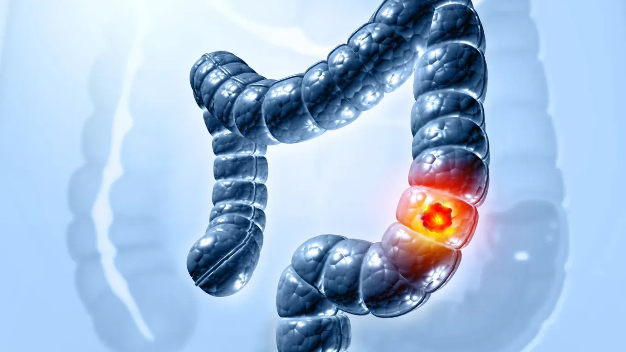 new-research-found-colibactin-toxin-reason-for-colon-cancer-in-youth