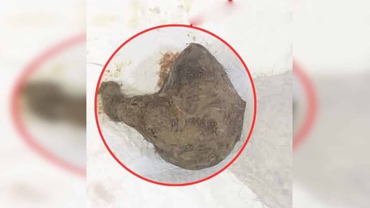 Hairs in stomach | 62 ఏండ్ల మహిళ కడుపులో 760 గ్రాముల వెంట్రుకలు తొలగింపు Hairs in stomach | 62 ఏండ్ల మహిళ కడుపులో 760 గ్రాముల వెంట్రుకలు తొలగింపు