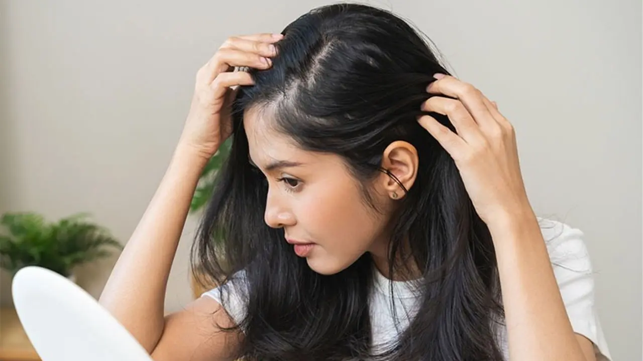 Dandruff Home Remedies : ఇంటి చిట్కాలతోనే చుండ్రుకు చెక్‌ పెట్టండి ఇలా..