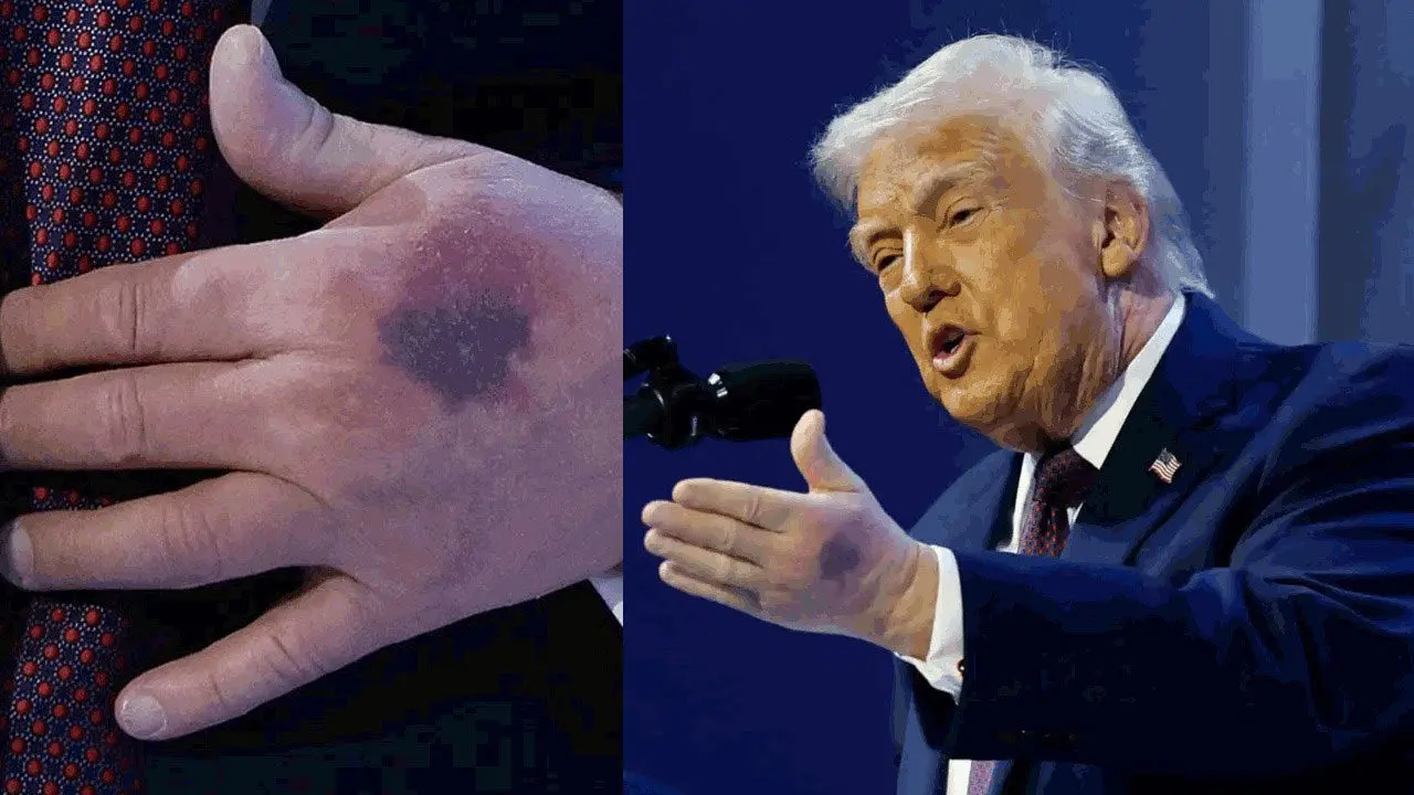 Donald Trump | ట్రంప్ చేతిపై కమిలిన గాయాలు.. అధ్యక్షుడి ఆరోగ్యంపై మరోసారి చర్చ..!