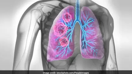 Lung Cancer | లంగ్ క్యాన్స‌ర్‌ను ముందే గుర్తించండిలా..