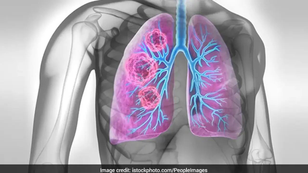 Lung Cancer | లంగ్ క్యాన్స‌ర్‌ను ముందే గుర్తించండిలా..