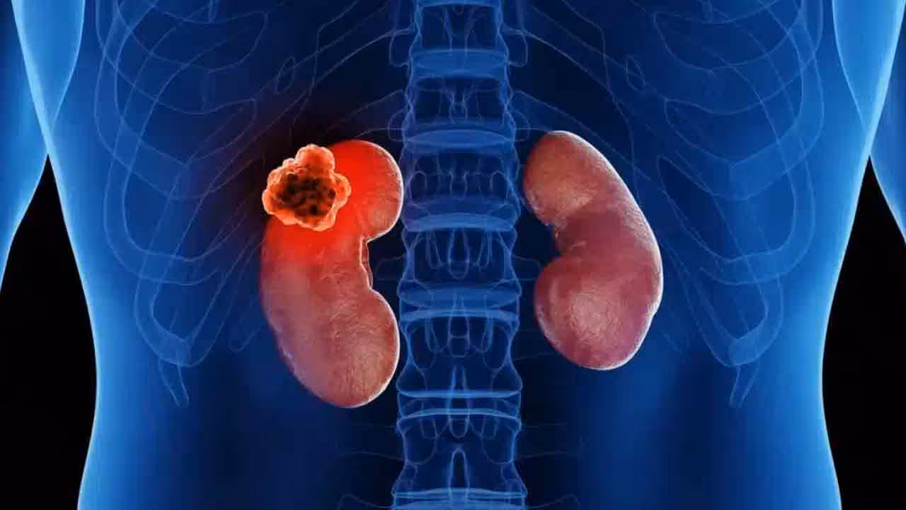 Kidney Tumor | అరుదైన శ‌స్త్ర చికిత్స‌.. ఓ రోగికి 20 సెం.మీ. కిడ్నీ క‌ణితి తొల‌గింపు
